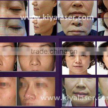 Distributor Price Hifu for Skin Tightening photo-4