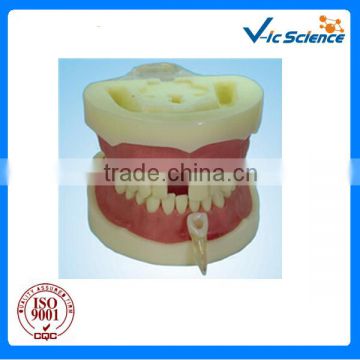 Root Canal Filling Model dental model