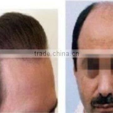 Professional Laser Hair Regrowth Machine/Diode Laser Hair Regrowth Machine