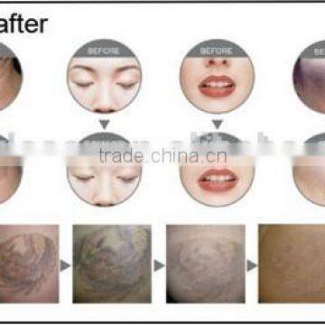 nd Yag Laser With Black Tip for Skin Whitening Laser Carbon Treatment photo-4