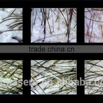 CE Professional Hair Growth /hair Restorer Equipment/ Low Level Diode Laser Therapy Hair Growth Device photo-4