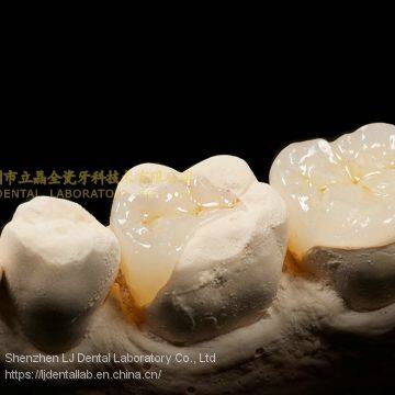 Dental crown e.Max ceramic, porcelain crown, dental veneers, laboratoire dentaire, Dentallabor, laboratorio dental, dental laboratory, Shenzhen LJ dental lab China