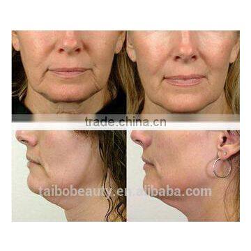 High Quality Fractional rf Facelift Machine/rf Micro Needle Remova Stretch Marks/fractional rf Facetreatment Machine
