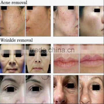 Portable Fractional Erbium Laser for Scars With CE Free Shipping photo-6