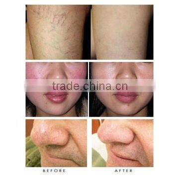 Spider Vascular Vein Removal Machine 980nm Diode Laser Varicose Veins Machine photo-6