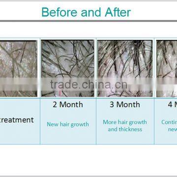 Diode Laser Hair Regrowth Machine/laser Cap for Hair Growth/hair Loss Treatment for Salon and Hair Transplantation Center photo-5