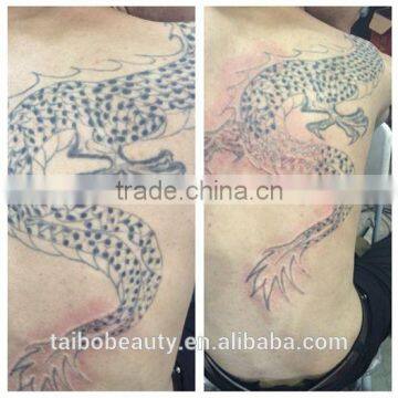 Tattoo Laser Removal Machine Tattooist Wanted Yag Picosecond Laser Tattoo Pigmented Lesions Treatment Removal Machine With 1064nm532nm Freckles Removal