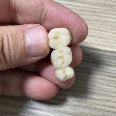 Metal Acrylic Dental Crown China Dental Laboratory photo-4