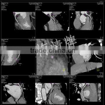 X-ray inkjet medical film for inkjet printer