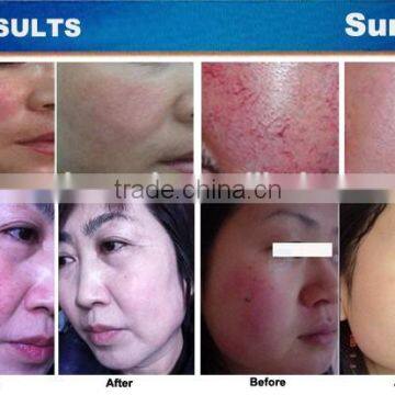 High Frequency Operation System and Blood Vessels Removal Feature Blood Vessel Removal photo-6