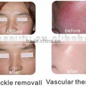 Wholesale Beauty Supply E-light+ RF+ nd Yag Laser Machine Looking for Distributors