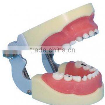 Tooth model children model shows children's dental caries carious pathology