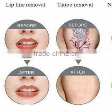 Multifunctional Nd-Yag Laser Tattoo Removal Machine Price for Black Doll Treatment