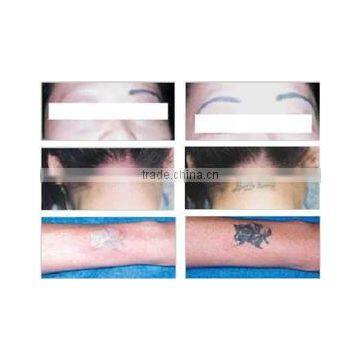 1 HZ 1600mj Strong Power Tattoo Removal Freckles Removal Q Switch Nd Yag Laser photo-2