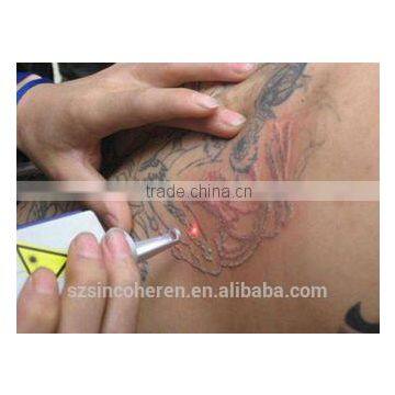 Most Effective Tattoo Removal Laser Equipment Removal Tattoo Laser photo-3