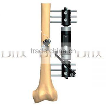 External Fixation For Bone Lengthening