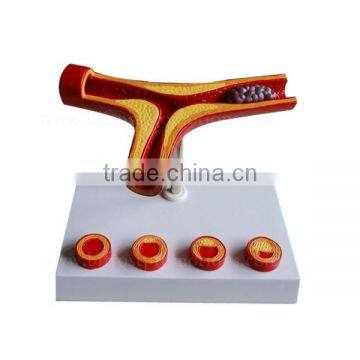 Thrombus Education Biological Teaching Human Body Anatomy Model photo-2