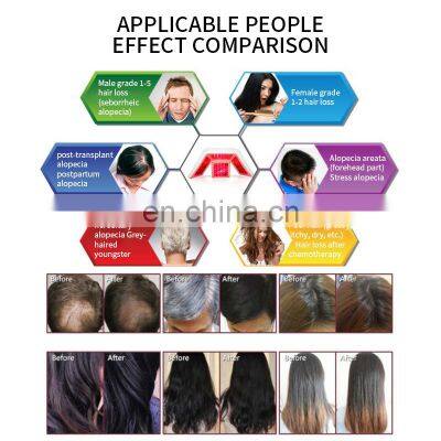Salon Professional Anti Hair Loss Laser Diodes Machine Hair Follicle Detection Analysis Scalp Massager Hair Growth Machine