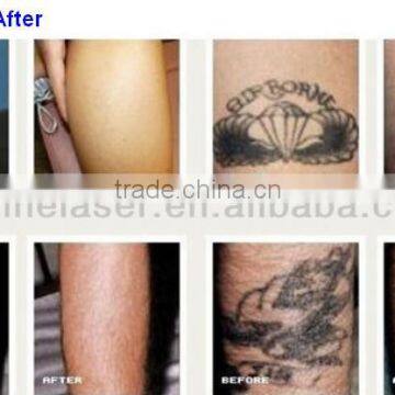 1-800ms Remove Tiny Wrinkle Best Nd YAG Diode Laser Beauty Tattoo Removal Bikini Hair Removal /birth Mark Removal /skin Rejuvenation Arms Hair Removal Clinic