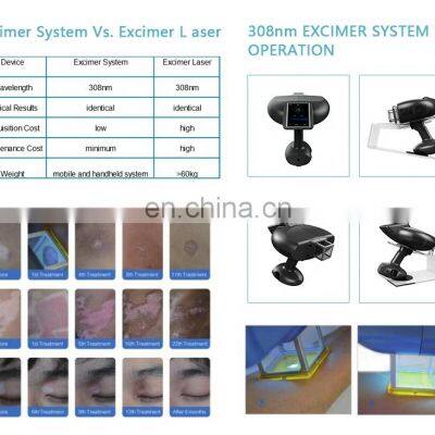 Excimer Laser 308nm Psoriasis Vitiligo Light Laser Treatment Machine photo-5