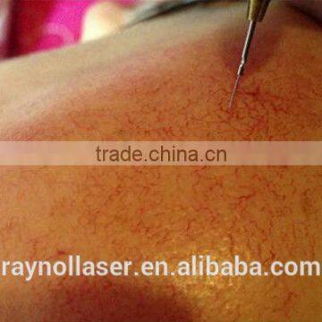 Smart Mini Spider Vein Removal Machine 30MHz RBS photo-6