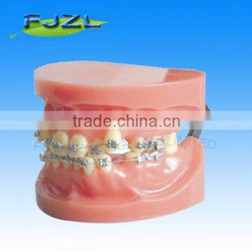 orthodontic teeth model(malocclusion teeth)/dental orthodontic models