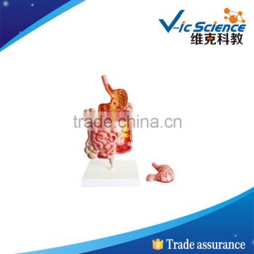 Best price good quality Digestive system diseases model 100% factory