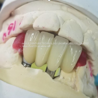 Smooth Surface Biocompatible Zirconia Tooth Crown Easy Maintain