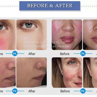 980nm Diode Laser Vascular Removal Machine and Spider Vein Treatment Machine photo-4