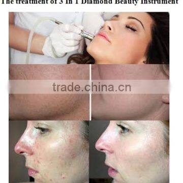 2015 Cheapest Punta de Diamante Microdermabrasion Maquina Keywords Facial Peeling Diamond Microdermabrasion Machine photo-6