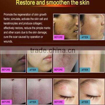 NEWEST! Face Whitening Acne Scar Treatment and Pimple Removal Cream photo-4