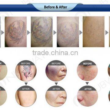 Q Switch Laser Tatoo Removal / nd Yag Laser / Eyebrows / Age Spot Removal photo-5