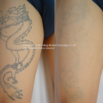 Q Switched Nd Yag Laser 1064nm&532nm Pigment Removal for Beauty Salon Use photo-5