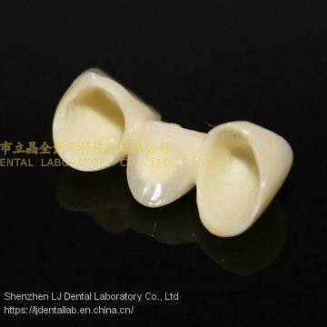 Dental Crown Zirconia PFZ, Dental Teeth, Dental Prosthesis, Laboratoire Dentaire, Dentallabor, Laboratorio Dental, Dental Laboratory, Shenzhen LJ Dental Lab China photo-4