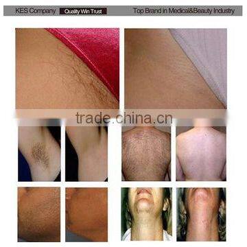 2016 Hot Sale 808nm Diode Laser Hair Removal Machine/hair Removal Speed 808 photo-6