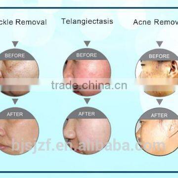 Redness Removal SH-2 2016 Most Popular Beauty Equipment New Style SHR /OPT/IPL+RF Multifunctional Ipl Hair Removal Opt Shr Ipl 2.6MHZ