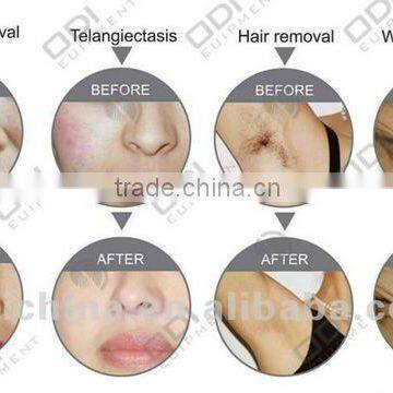 OD-A900 Beauty Machine for Skin Rejuvenation Fast Hair Removal Portable Ipl photo-4