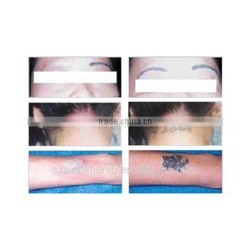 HOT Sell Sincoheren Nd:yag Laser Tattoo Removal Q-switch Skin Rejevenation. photo-5