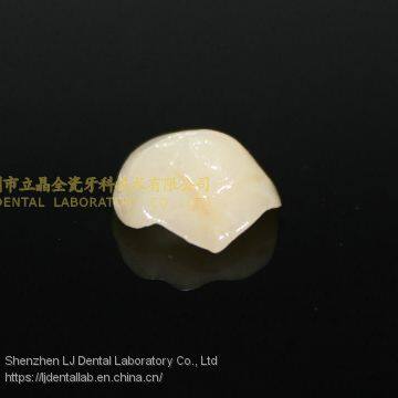 Dental Crown E.Max Ceramic, Porcelain Crown, Dental Veneers, Laboratoire Dentaire, Dentallabor, Laboratorio Dental, Dental Laboratory, Shenzhen LJ Dental Lab China photo-4