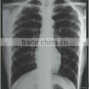 drystar 14 17 dt2b, medical x ray film of china zhejiang