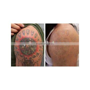 Birthmark and Tattoo Removal Machine From Chian Apolo HS-250