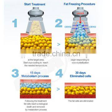 fr Fat Freezing Machine Cryotherapy Device photo-3