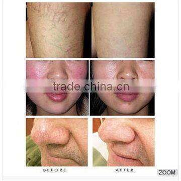 980nm Diode Laser Red Blood Removal/diode Laser 980nm Varicose Vein Removal photo-6