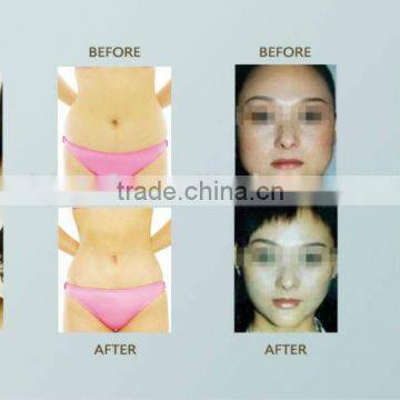 Slimming Equipment Cryo Freeze Cellilite Cellulite Reduction Reduction Cryolipolysis Fat Freezing Machine SL-4 Fat Freezing