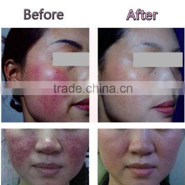 Portable High Frequency Blood Vessel Laser Therapy Machine photo-6