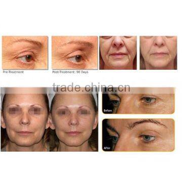 Portable High Frequency Face Machine Professional Face Lifting Machine Prices Hifu Fda Approval 0.1-2J photo-5