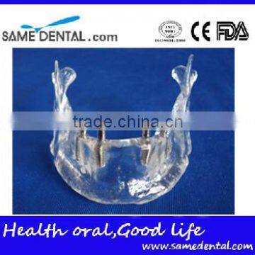 Hot Sale Transparant Mandibule Implant Model