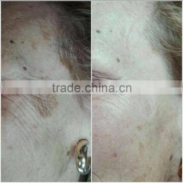 Best Matrix rf Fractional With Microneedle Machine for Wrinkle Removal