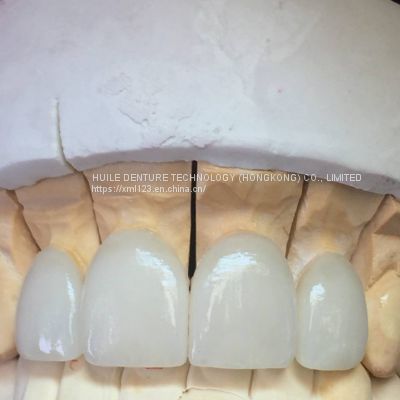 Full Porcelain Crowns America Outsourcing Dental Lab