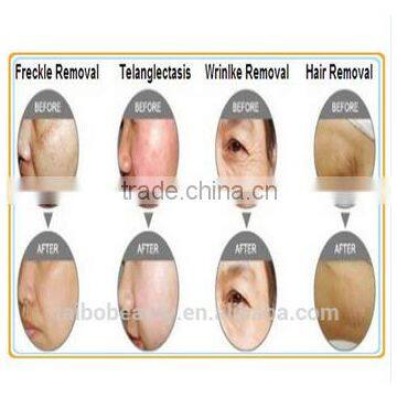 Remove Diseased Telangiectasis Portable Home Use Ipl Shr Vertical Hair Removal Machine For Beauty Spa Salon Speckle Removal
